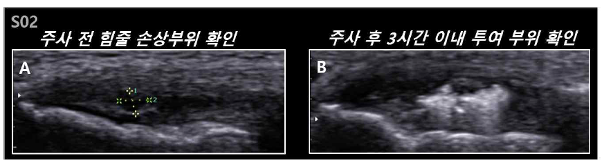 연구대상자 (S02)의 임상 의약품 주사 전(A), 주사 후 3시간 이내(B)의 초음파 소견