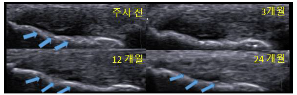 연구대상자 (S02)의 임상 의약품 주사 전 및 주사 후 3개월, 12개월, 24개월 추적관찰 시의 초음파 소견. 화살표 부위의 결손이 호전되는 것이 확인 됨