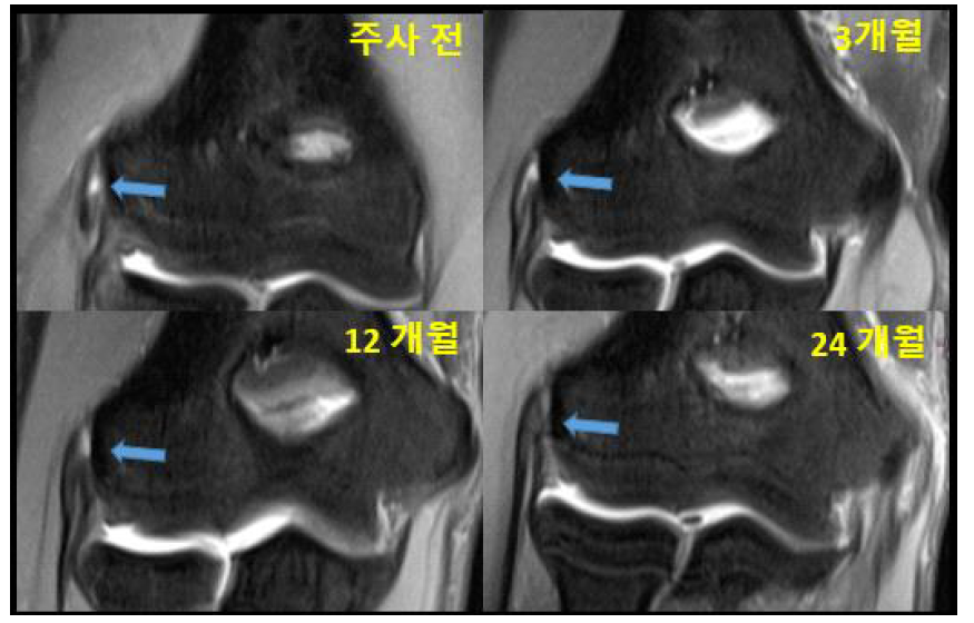 연구대상자 (S12)의 임상 의약품 주사 전 및 주사 후 3개월, 12개월, 24개월 추적관찰 시의 MRI 소견. 화살표 부위의 결손이 호전되는 것이 확인 됨