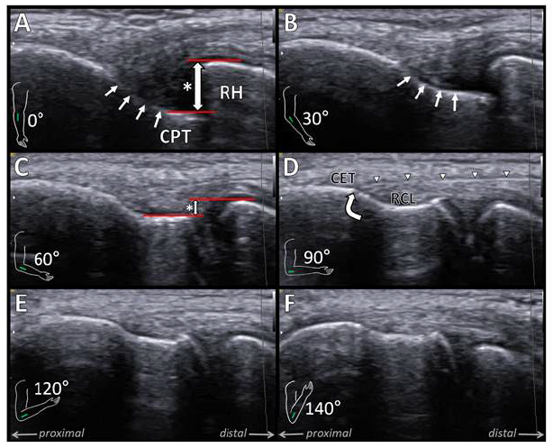 팔꿈치 각도에 따른 요골 외측 인대 (RCL, radial collateral ligament)의 초음파 변화, 요골 골두 (RH, radial head)와 capitellum(CPT) 의 초음파상 높이 차이를 측정, CET, Common extensor tendon