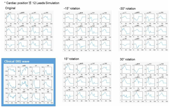 Clinical EKG p-wave와 5가지 형태로 설정한 가상 심장모델에서의 각 위치에 대한 simulation p-wave의 12-Lead EKG 분석 결과