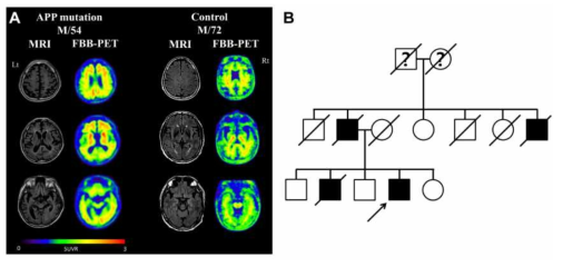 APP-V715M 유전변이 환자와 정상인의 뇌영상 소견(A) 및 환자 가계도(B)