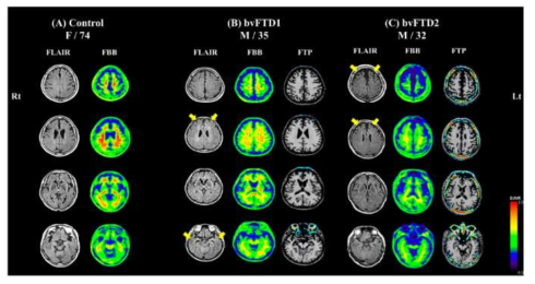 정상인과 2명의 bvFTD 환자의 뇌영상 소견