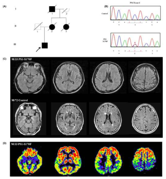 PS1-S170F 유전변이 환자의 가계도(A), 유전변이(B), MRI(C), 및 FDG-PET(D)