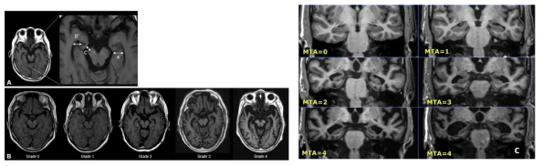 Visual rating scale of medial temporal atrophy on T1-weighted image. (A’: width of the hippocampus, C’: width of the perimesencephalic cistern, D’: width of the temporal horn)