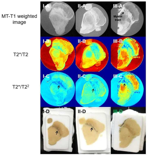 정상군과 사후 뇌조직의 멀티 컬러 철영상 분석 MRI 영상과 섹션 중 단면 촬영 영상