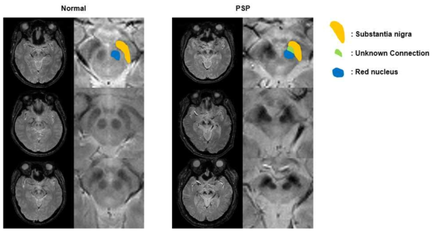 3T 임상용 MRI에서 정상군과 진행성 핵상 마비 환자군의 흑질 영상
