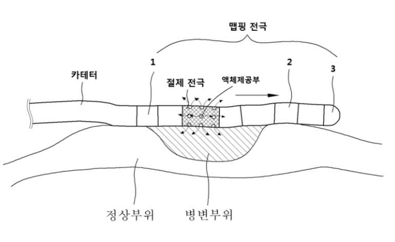 개발하고자 하는 전극카테터 도식