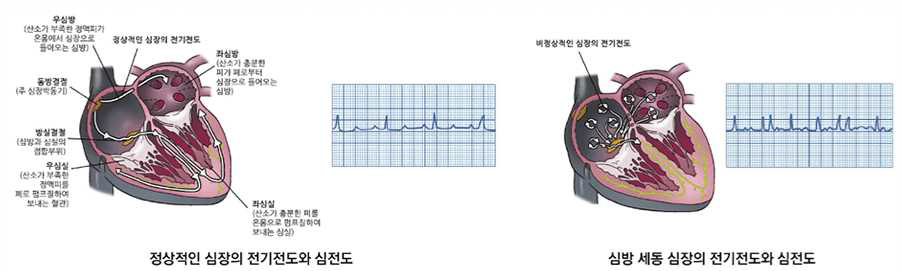 심장의 전기전도와 심전도 비교