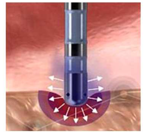 전극카테터가 병변에 점접촉하는 모습