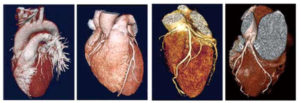 심장 CT angiogram 데이터