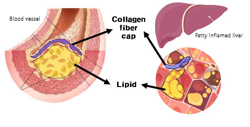 관상동맥내의 동맥경화반과 지방간 모델에서도 고지방 조직의 분포
