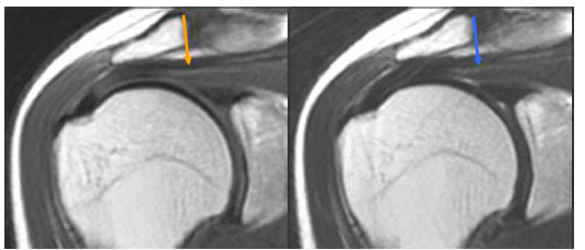 어깨 힘줄과 MRI 마그네틱 필드의 각도에 따른 힘줄 MRI 영상의 변화