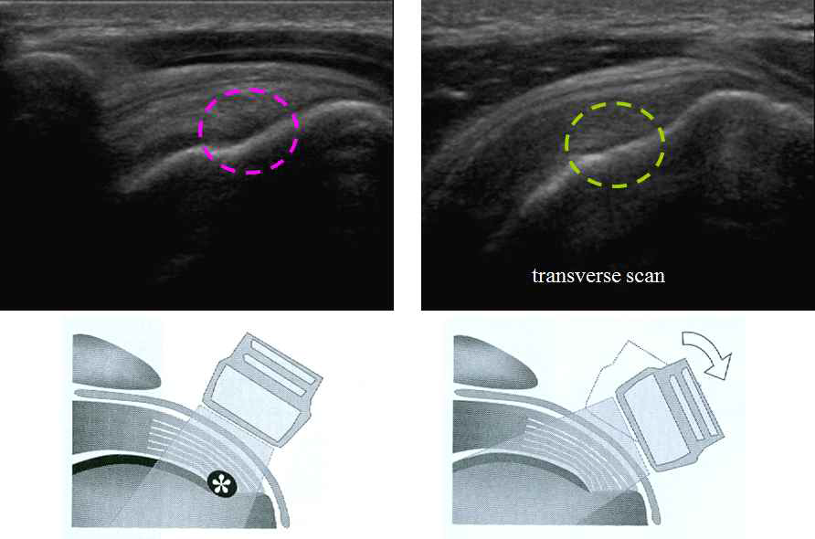 어깨 힘줄과 초음파 프로브 사이의 각도에 따른 힘줄의 초음파 영상의 변화