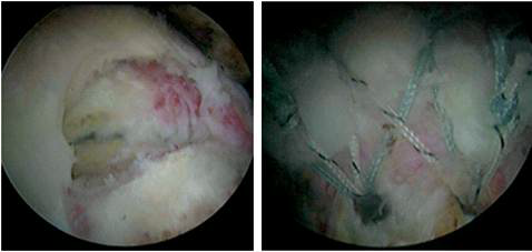 만성 어깨 힘줄 파열의 관절경소견(좌) 및 봉합술을 시행한 후의 수술 사진(우)