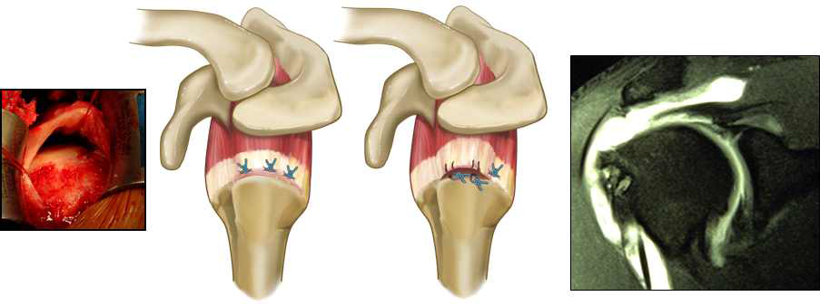 만성 광범위 어깨 힘줄 파열과 어깨 힘줄 합술 후 재파열 사진 (좌: 디지털 사진, 우: MRI 사진)