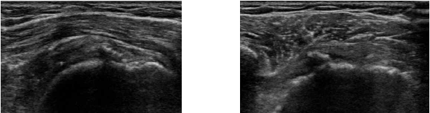 만성 광범위 어깨 힘줄 파열의 힘줄 봉합 수술 후 2년째 초음파 사진 (좌: 장축 단면, 우: 단축 단면). 삽입된 비흡수성 봉합사의 artifact(acoustic shadowing)로 봉합부 힘줄이 마치 파열된 것처럼 보이는 재파열 여부 진단에서 초음파의 제한점 보여주는 사진