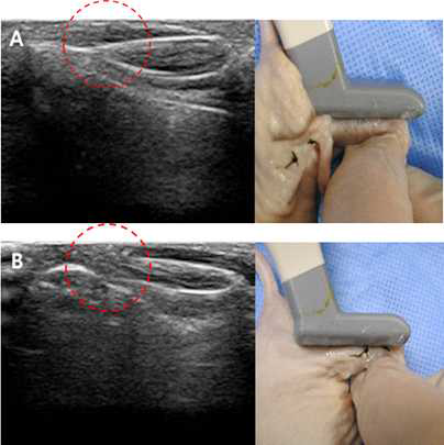 Nude mouse의 (A)정상 아킬레스 힘줄과 (B)파열 힘줄의 초음파 영상