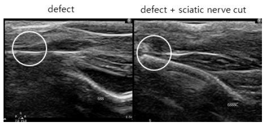 아킬레스 힘줄의 1mm 부분 절제 및 좌골신경 절단 후 5일째 결손부 초음파 영상
