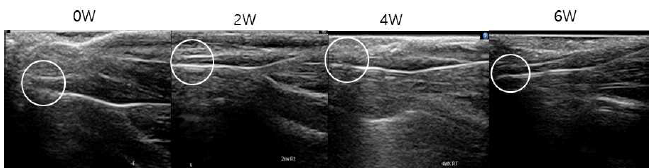 아킬레스 힘줄의 주사바늘 이용한 최소 절개 및 좌골신경 절단 후 5일째 결손부 초음파 영상