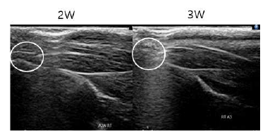 아킬레스 힘줄의 블레이드(No.11) 이용한 최소 손상 후 2주, 3주째 손상부 초음파 영상