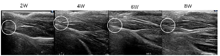 소상된 힘줄의 치료후 주별로 관찰한 초음파 영상