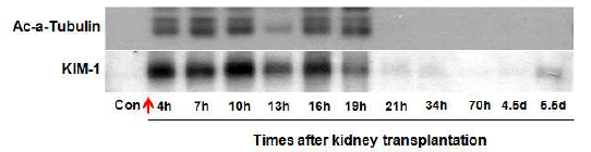 신장이식 환자의 오줌 샘플에서의 일차섬모 단백질과 Kim-1의 변화. 신장암 환자의 오줌 샘플을 westernblot 기법을 이용하여 acetylated-α-tubulin과 Kim-1 단백질 발현을 확인함