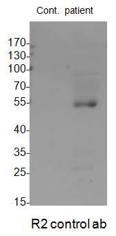 신장이식 환자의 오줌 샘플에서의 acetylated-α-tubulin 확인. 신장 질환 환자의 오줌 샘플을 western blot 기법을 이용하여 acetylated-α-tubulin 단백질 발현을 확인함