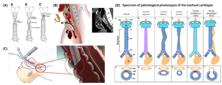 (A) 다양한 기관 협착, (B) 기관 절개술에 의한 기관 손상, (C) 후천적 기관 협착의 주요 원인인 기도 삽관, (D) 다양한 선천성 기관 결손