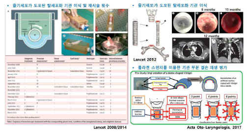 기관 협착·결손 치료 동향