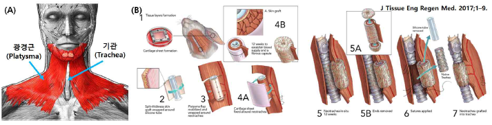 (A) 광경근과 기관의 위치. (B) 타 조직에 지지체 이식 후 질환 조직으로 이식하는 two-stage 수술 기법