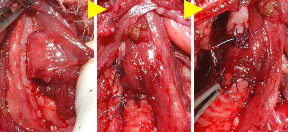 Matrigel-coated PCL scaffold를 strap muscle에 일차 이식 4주 후, 기관 결손 부위로의 이차 이식. (노란색 화살표: 이식 순서)