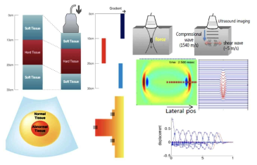 (A) strain elastography 와 (B) shear wave elastography 의 물리적 원리. http://www.samsungmedison.com/technology/elastoscan.jsp, with permission from Samsung Medison. Shin DK. Principles of ultrasound elastography. In: Korean Society of Ultrasound in Obstetrics and Gynecology. Korean Society of Ultrasound in Obstetrics and Gynecology workshop; 2015 Oct 24; Seoul, Korea. Seoul: Korean Society of Ultrasound in Obstetrics and Gynecology