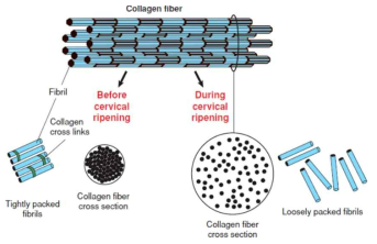자궁경부의 콜라겐의 구조 (모식도). 자궁경부의 숙화(ripening)이 이루어지기 이전에는 compact하게 배열되어 있다가, 자궁경부의 숙화가 일어나면서 콜라겐 fiber의 배열이 loose하게 된다