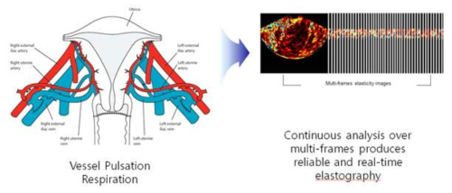 자궁경부에 압력을 가하지 않고 주변의 혈관박동을 이용하여 영상을 생성하며, 단 한 장의 영상이 아니라 51개의 영상을 처리하여 자궁경부탄성도 검사 지표와 영상을 생성함
