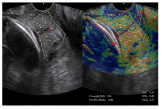 E-Cervix 자궁경부탄성도검사법. 그림 10.에 비해 좀 더 일관되고 표준화된 영상을 얻을 수 있음