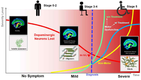 퇴행성뇌질환 (PD) 환자의 늦은 진단 시기 및 치료 한계로 인한 신경세포의 손실