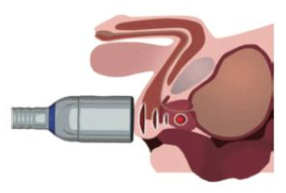 회음부를 통한 체외충격파 치료 모습 (intraprostatic focus)