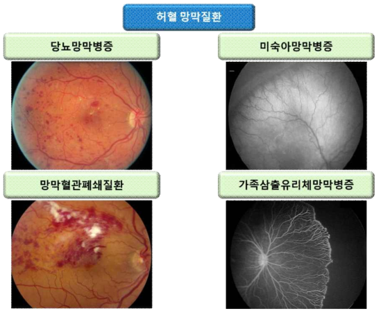 실명을 유발하는 허혈 망막질환