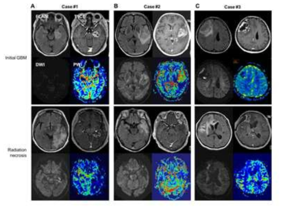 MRI characteristics of GBM and radiation necrosis in each case