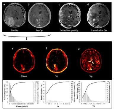 뇌교모세종환자에서 얻은 DCE MRI 분석의 예