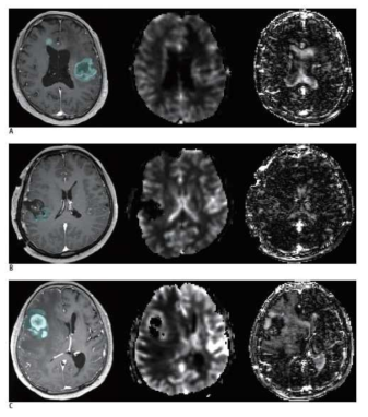 ALADDIN 방법이 brain grey matter 의 nCBF 값을 잘 감지 할 수 있으며, 원발성 뇌종양에서도 기존의 DSC 관류 자기공명영상에 비하여 높은 관류 부위를 더 잘 감지할 수 있음