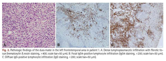 자가면역 경막염 환자의 경막 조직염색