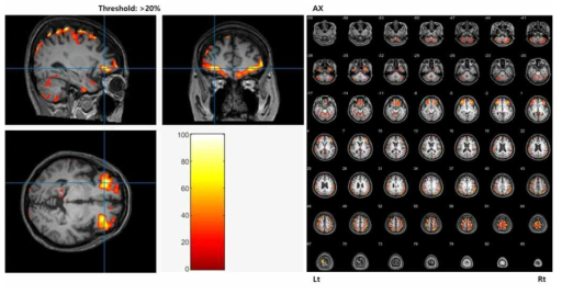 PET/MRI 정합 영상