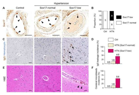 만성 고혈압 환자 병리표본에서 Sox17 유전자 발현과 뇌혈관방벽 누수를 면역염색을 통하여 확인 함