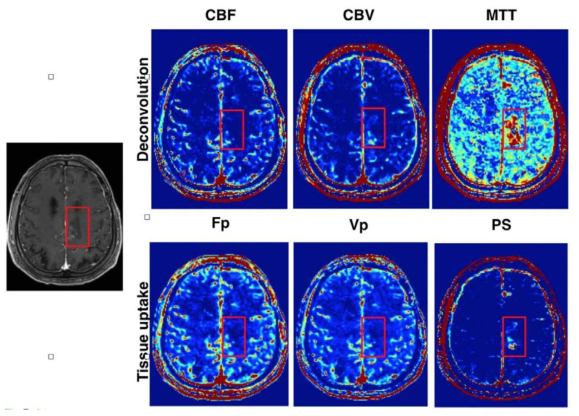 고해상도 동적 MRI 영상으로부터 추출한 정량화 수치 (CBF: blood flow, CBV: blood volume, MTT: mean transit time, Fp: plasma flow, vp: plasma volume fraction, PS: permeability surface area product)