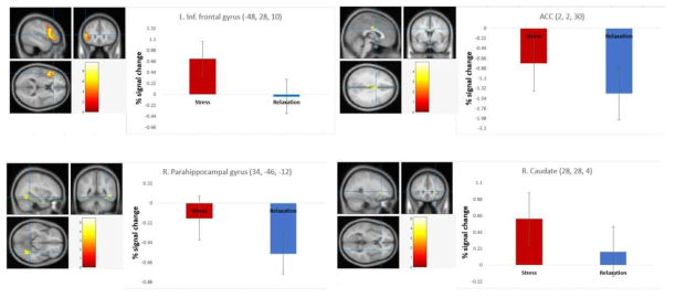 알코올 중독자에서 이완 조건에 비해 스트레스 동안에 나타난 뇌 활성화 (빨간색: 스트레스 조건, 파란색: 이완 조건; uncorrected, p < .001)