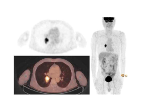 폐암 환자의 PET/CT 영상