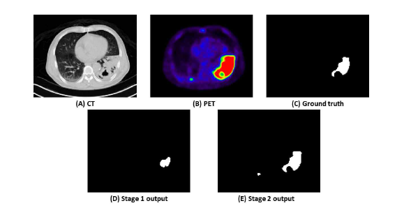 CT, PET, ROI 영상과 1단계와 2단계 예측 결과