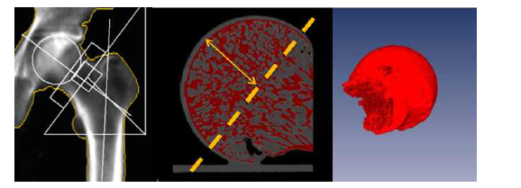 DXA를 이용한 건측의 골밀도 측정 및 micro-CT를 이용한 환측의 골밀도 측정. 환측의 micro-CT의 경우 채취된 골두가 모두 포함되도록 골두의 골표면 내측에서 3cm 까지의 반원구를 포함하여 측정